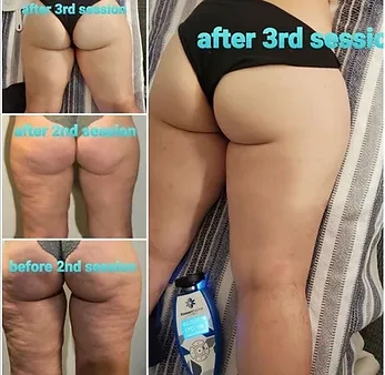 Wellness Care Lawrenceville GA Booty Cryo Before After