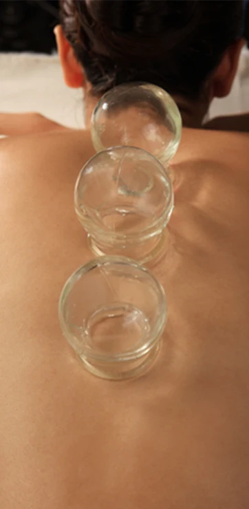 Wellness Care Lawrenceville GA Woman With Cupping On Her Back